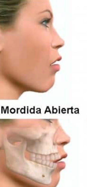 Cirugía Ortognática Mordida Abierta