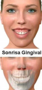 Cirugía Ortognática Sonrisa Gingival