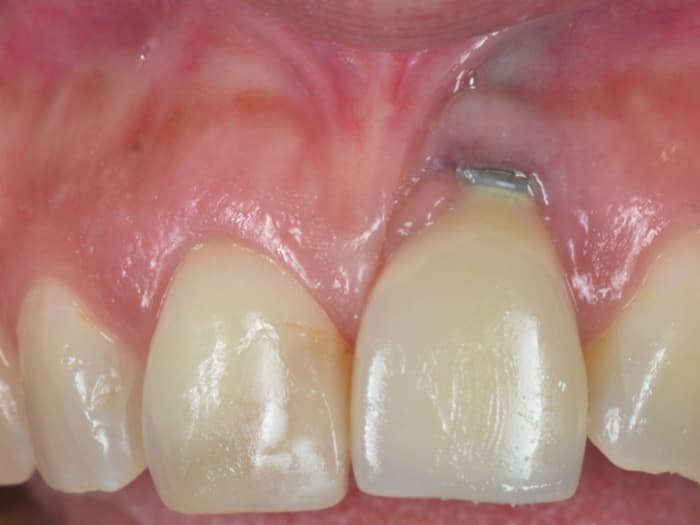 Diagnóstico Desastres Estéticos Con Implantes Dentales