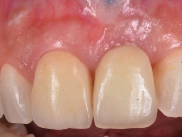 Tratamiento Desastres Estéticos Con Implantes Dentales