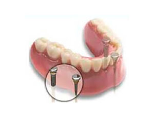 Procedimiento - Implante de dientes
