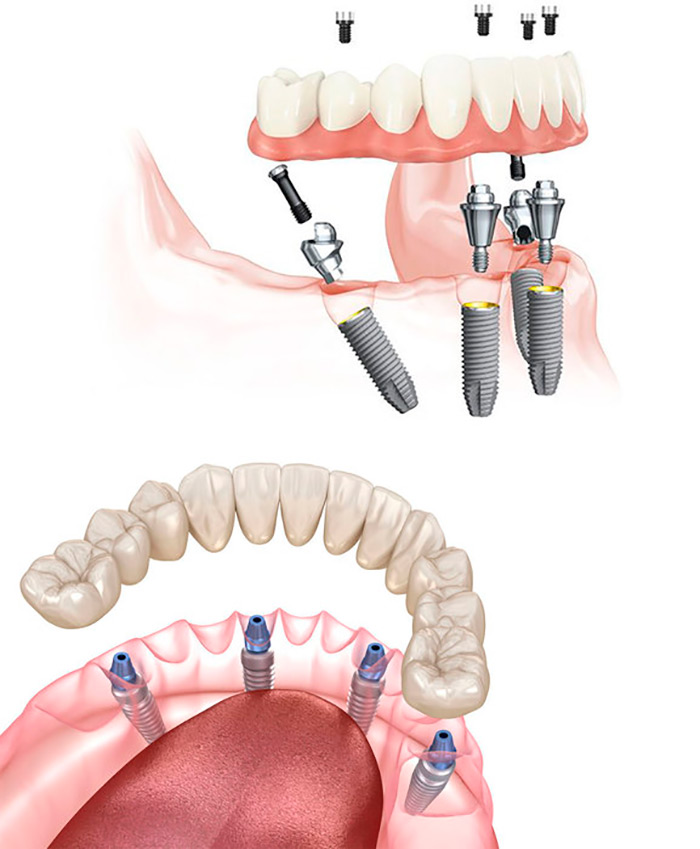 Procedimiento - Implante de dientes