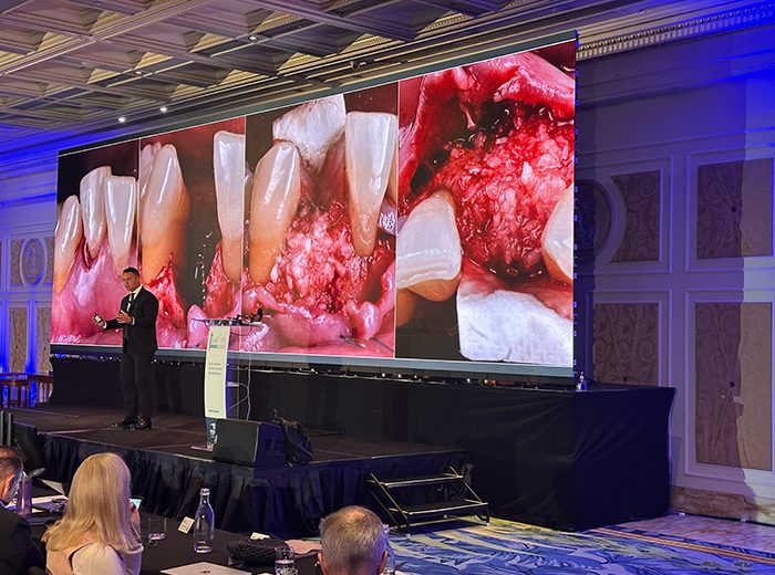 El Dr. Alberto Monje dio una charla sobre cómo prevenir y manejar complicaciones en la terapia con implantes en un simposio internacional en Australia.